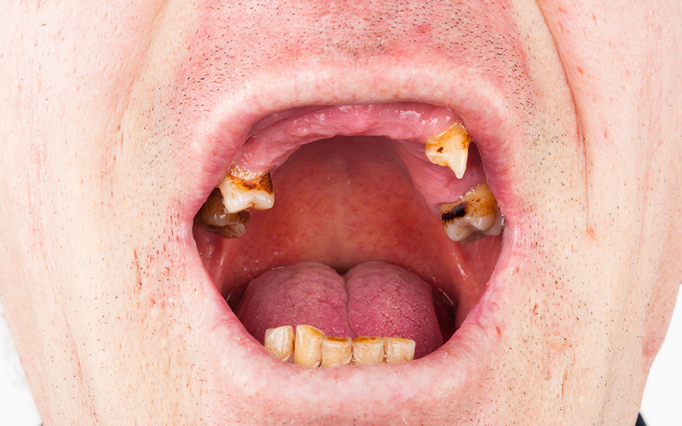 保険治療では救えない歯がある