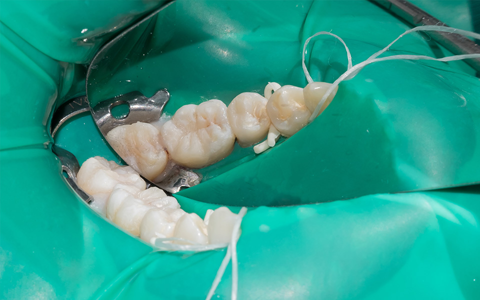 特徴01 世界基準のラバーダム防湿法による再発防止対策